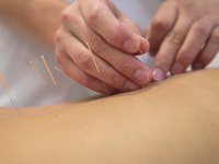Ear Acupuncture Group Visit Offered by Dr. Lisa Koers Integrative Family Physician | Trained in Medical Acupuncture