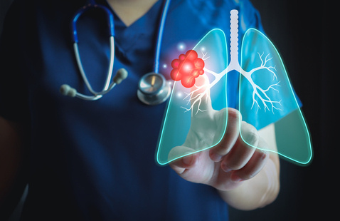 Image of Advances in Lung Cancer Detection and Treatment of Early-Stage Lung Cancer