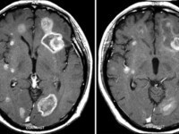 Brain Metastasis Tumor Board