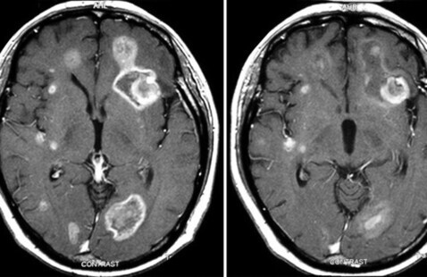 Image of Brain Metastasis Tumor Board